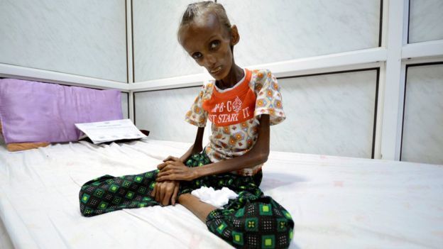 التايمز: ملايين يتضورون جوعا في حرب اليمن المنسية