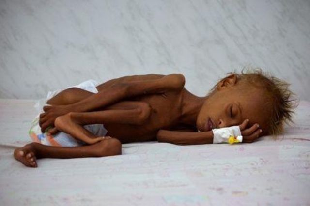وكالات دولية: أكثر من مليون طفل يمني يعانون الجوع مع اشتداد الحرب