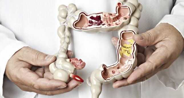 Colon and rectal cancer rates rising sharply among Gen X, millennials