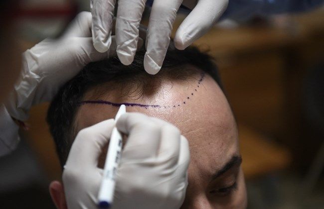 Hair transplants boost Istanbul's receding tourism