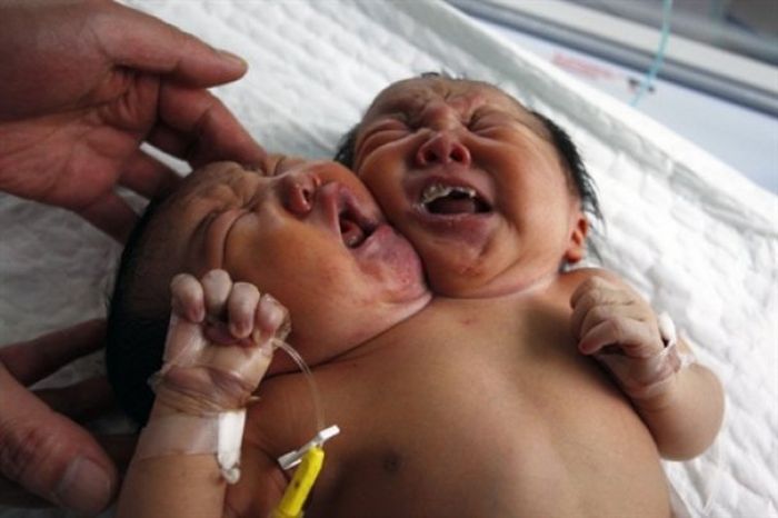 В Индии родился ребенок с двумя головами