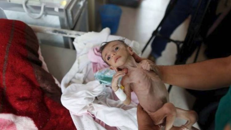 أسوشيتد برس: مجاعة اليمن سببها حصار التحالف السعودي الإماراتي للحديدة
