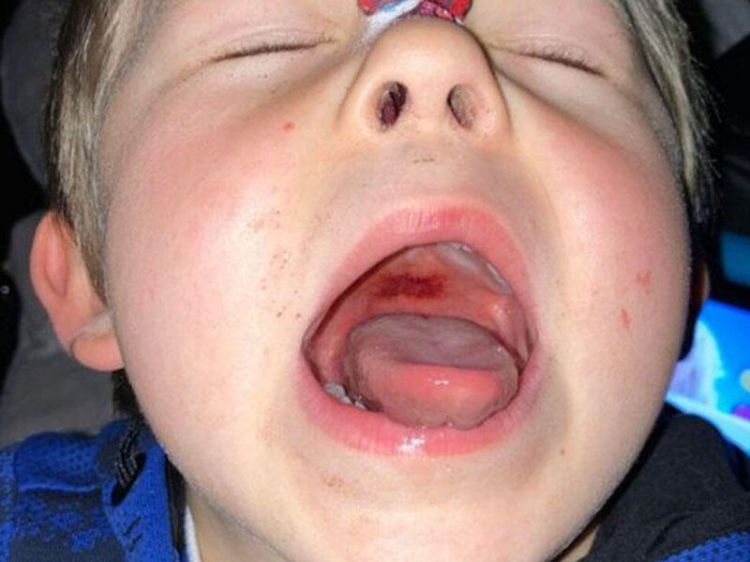 Uşaqlar arasında "Strep A" infeksiyası yayılır