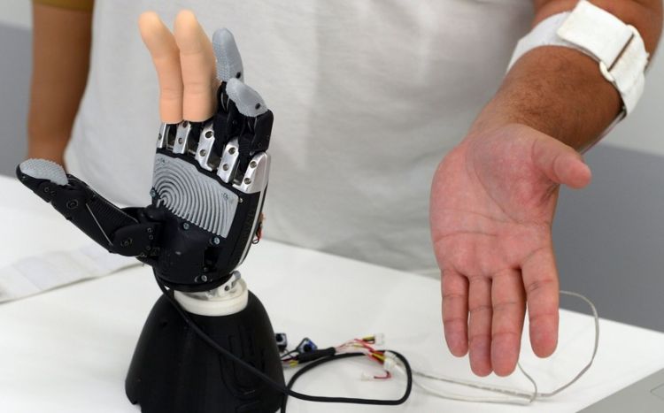 Ученые создали бионический имплантат, позволяющий контролировать все пальцы протеза